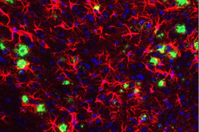 Reactive astrocytes around plaques