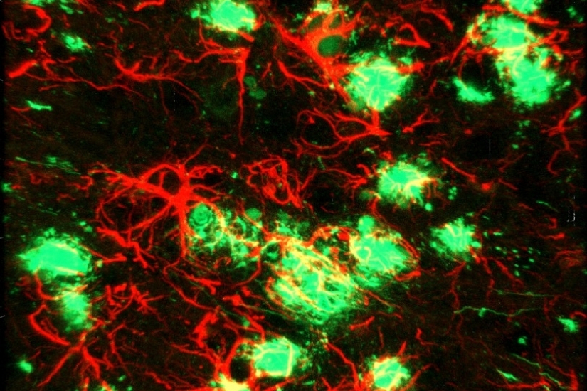 Reactive astrocytes around plaques