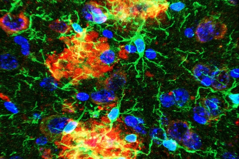 Microglial phagocytosis of amyloid plaques